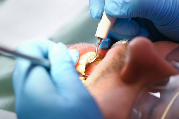 Best Emergency Tooth Extraction in Trinity, TX